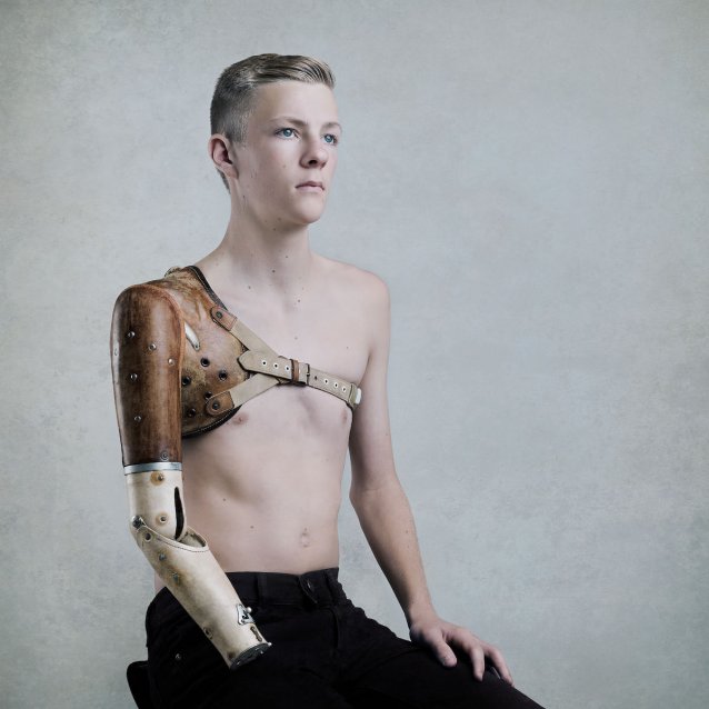 Cameron and the prosthetic arm, 2016