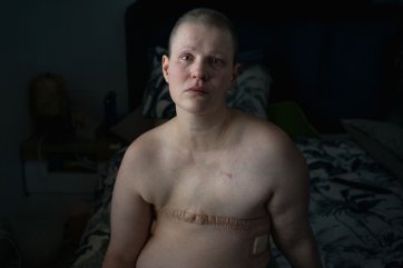 Breast cancer, age 37