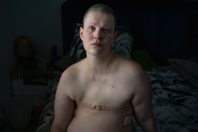 Breast cancer, age 37, 2021