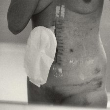 Self portrait after surgery, 1979 Carol Jerrems