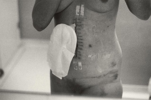 Self portrait after surgery, 1979